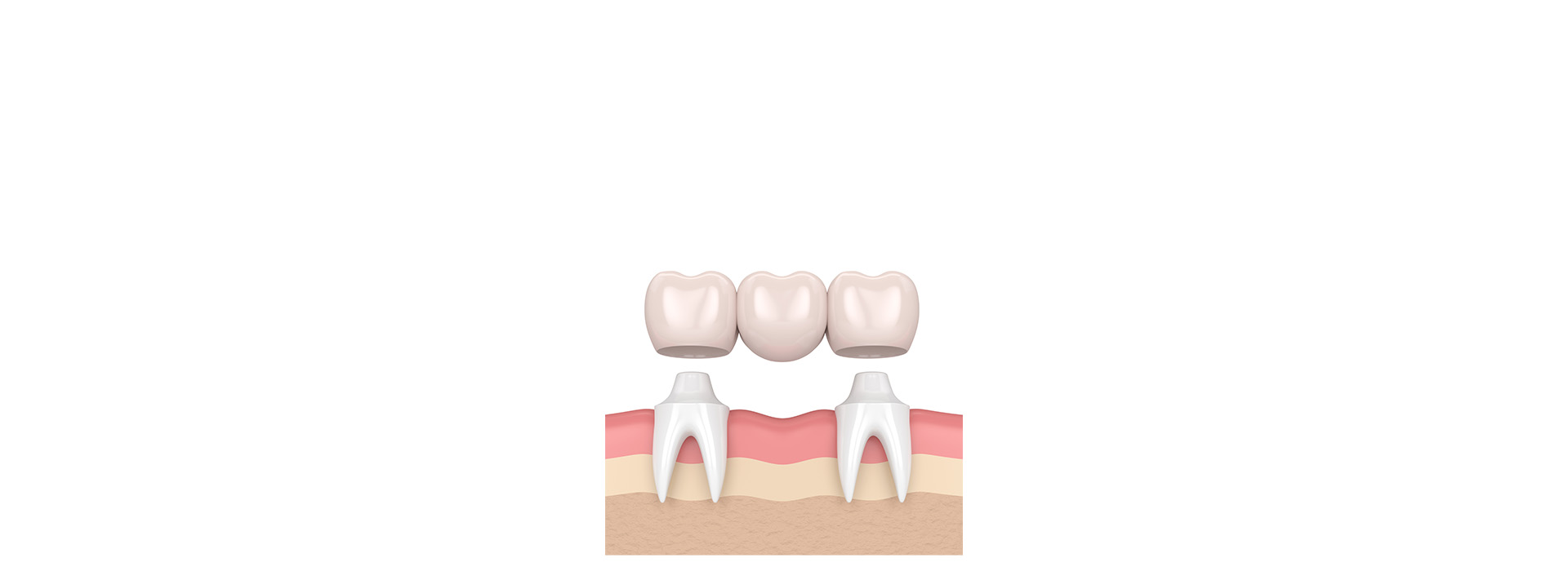 Noble Dental Studio | Dental Bridges, Digital Radiography and Night Guards