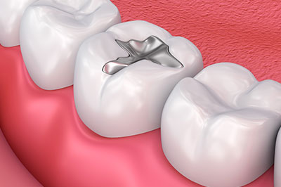 Noble Dental Studio | All-on-6, Invisalign reg  and Laser Dentistry