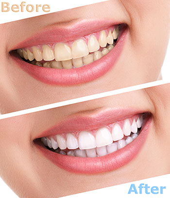 Noble Dental Studio | Night Guards, Veneers and ClearCorrect reg 